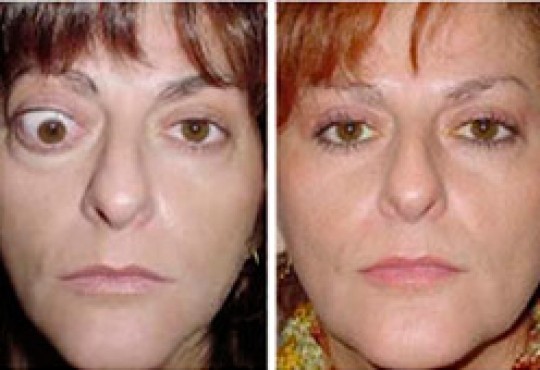 Img Oftalmopatía de graves